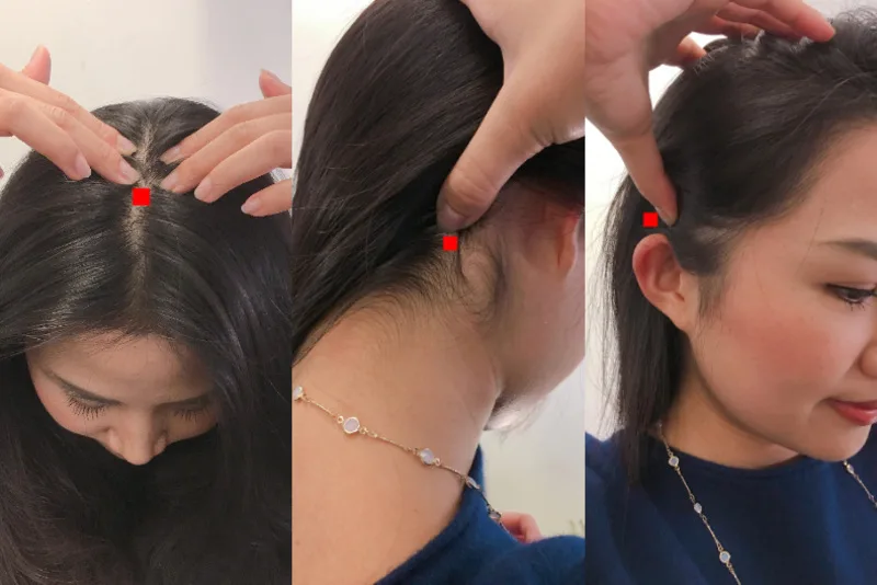 Đường ngôi rộng và tóc thưa ở đỉnh đầu có thể phản ánh tình trạng giảm mật độ tóc