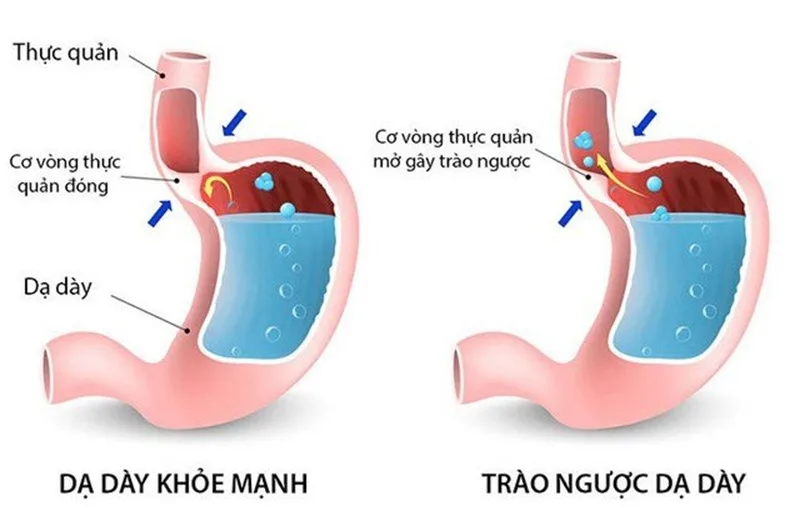 trao nguoc da day kieng an gi