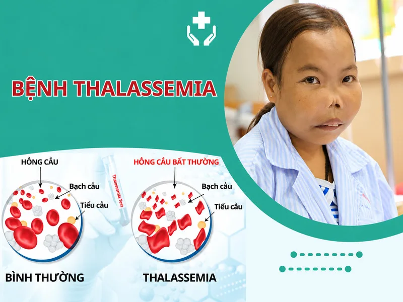 Tan máu bẩm sinh hay Thalassemia là bệnh di truyền ảnh hưởng quá trình tạo hemoglobin